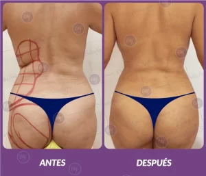 Lipotransferencia 11